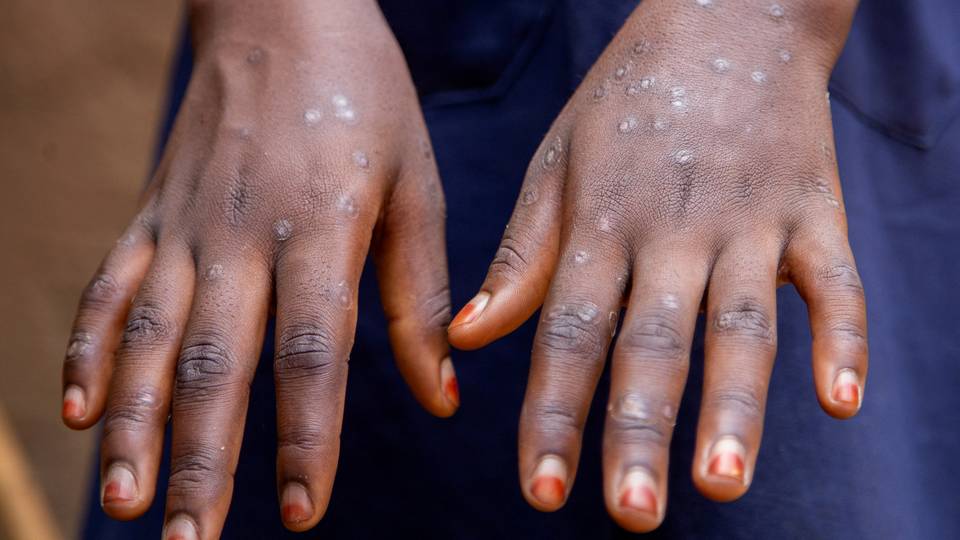 Le Rwanda lance sa campagne de vaccination contre la variole
