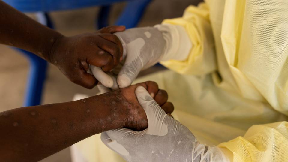 WHO raises alarm over low mpox testing in epicentre DRC