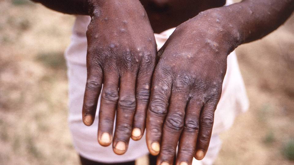 Mpox: l'OMS craint une propagation internationale de l'épidémie depuis la RDC