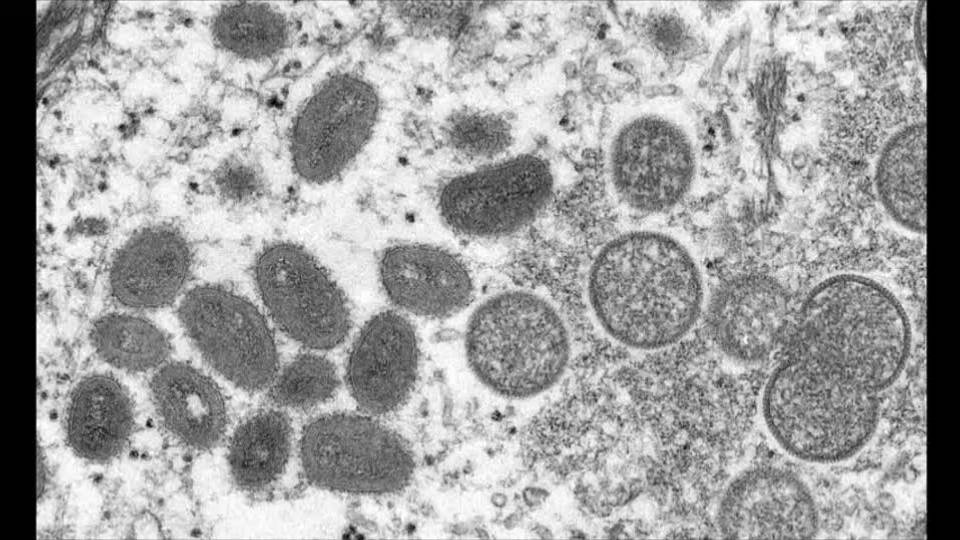Mpox: First case confirmed in Kenya