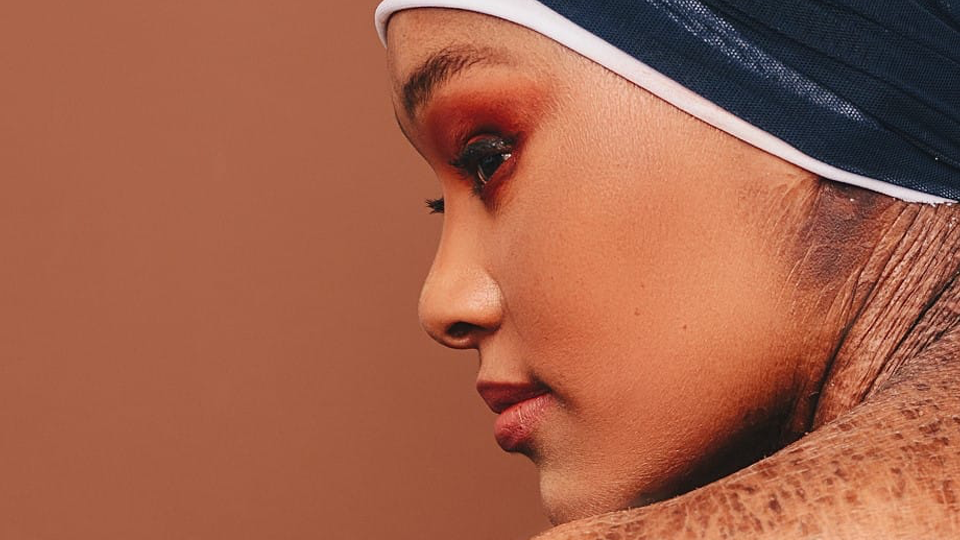 Zoey's triumph: Beauty beyond skin and stigma
