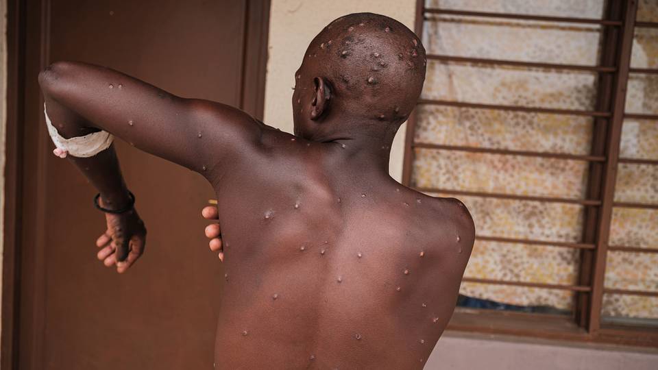 Congo:  21 cas de mpox confirmés