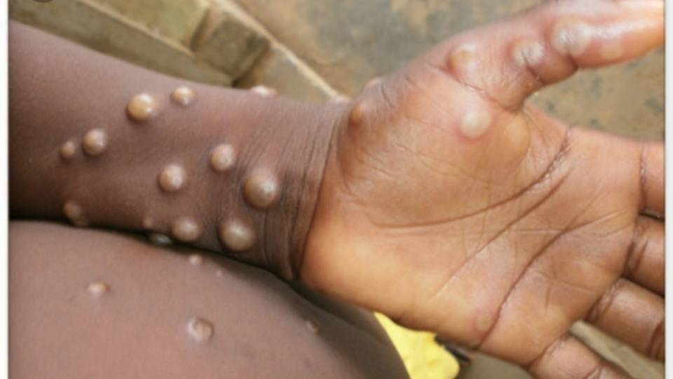 Le Burundi signale 3 cas de variole