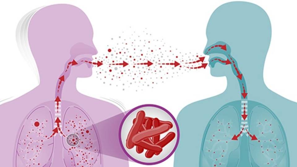Angola records more than 50,000 tuberculosis cases
