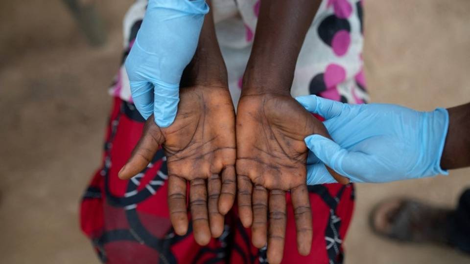L'OMS "très inquiète" de la propagation de la variole en RDC