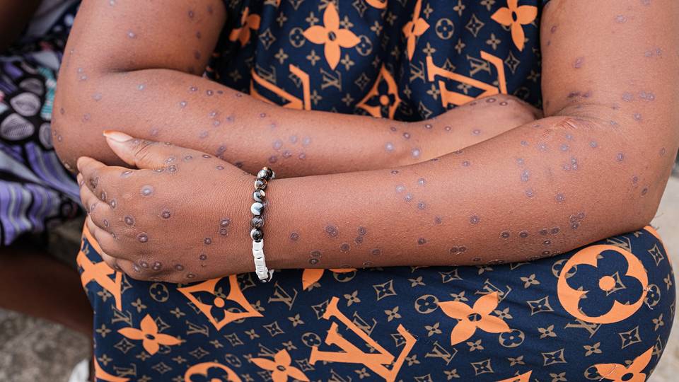 Why is Congo struggling to contain mpox?