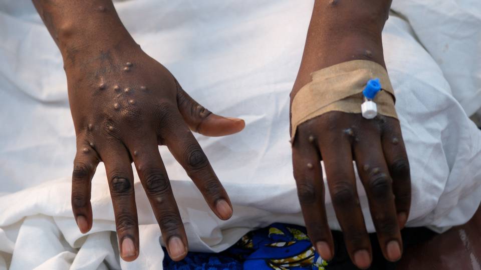 Mpox virus: Plan unveiled for Africa-wide emergency response