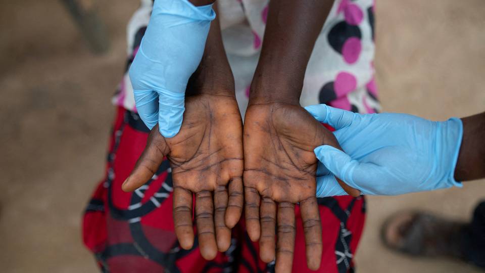 L’OMS alerte sur une situation sanitaire "catastrophique" en RDC