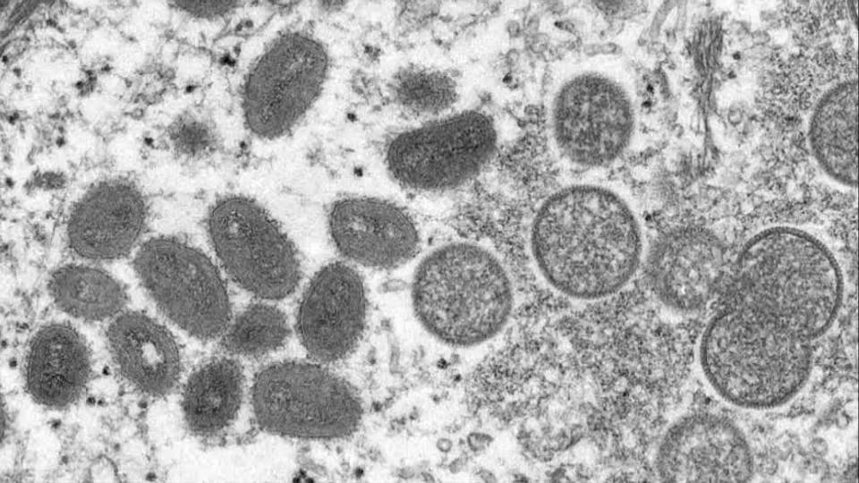 Second death from mpox virus reported in South Africa