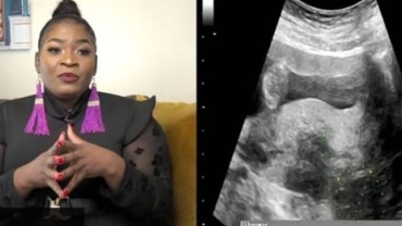 Owamie: South African influencer on living with fibroids