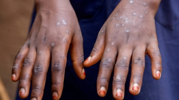 South Sudan latest to declare mpox outbreak