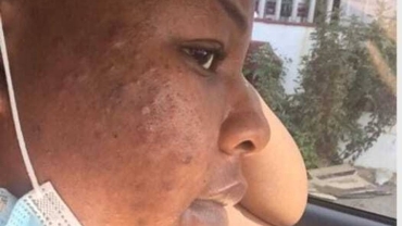 Cystic acne gets under one's skin in more ways than one