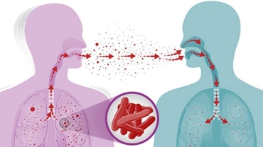 Angola records more than 50,000 tuberculosis cases