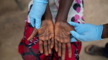 L'OMS "très inquiète" de la propagation de la variole en RDC