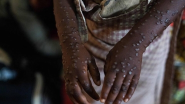 Mpox cases in Nigeria spread to capital and 20 states