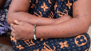 Kenya confirms more mpox cases as outbreak spreads